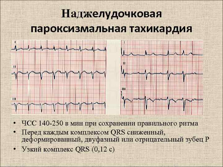 Нарушение ритма сердца карта вызова