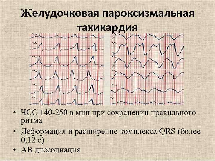 Желудочковая тахикардия на экг