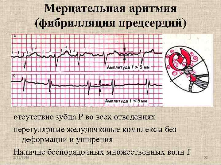 Нерегулярность ритма сердца процентах