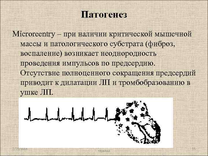 Патогенез Microreentry – при наличии критической мышечной массы и патологического субстрата (фиброз, воспаление) возникает