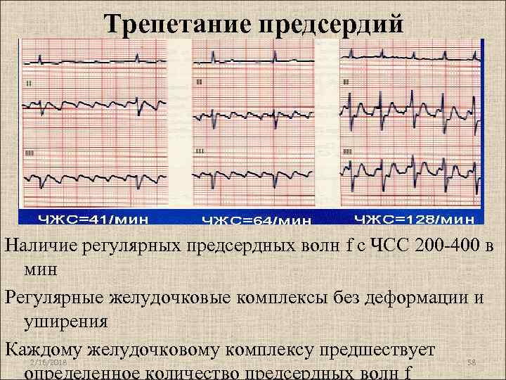 Типы трепетания предсердий. Трепетание предсердий классификация на ЭКГ. Частота сокращений предсердий при трепетании предсердий.