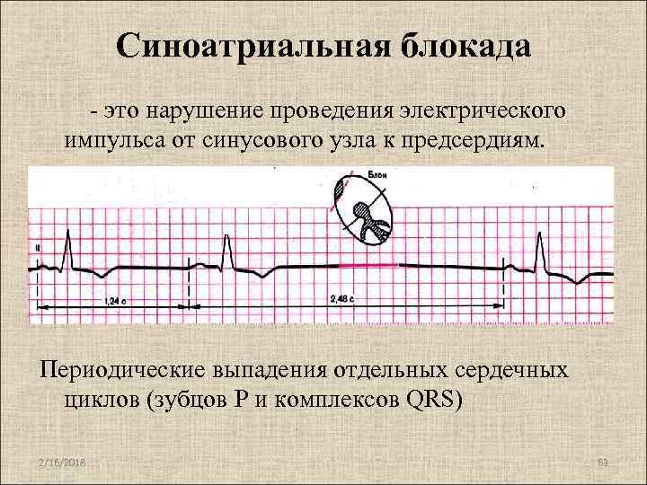 Синоатриальная блокада типы