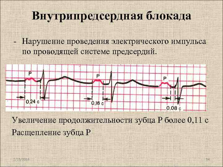 Внутрипредсердная блокада - Нарушение проведения электрического импульса по проводящей системе предсердий. Увеличение продолжительности зубца