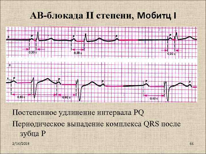 Блокада qrs