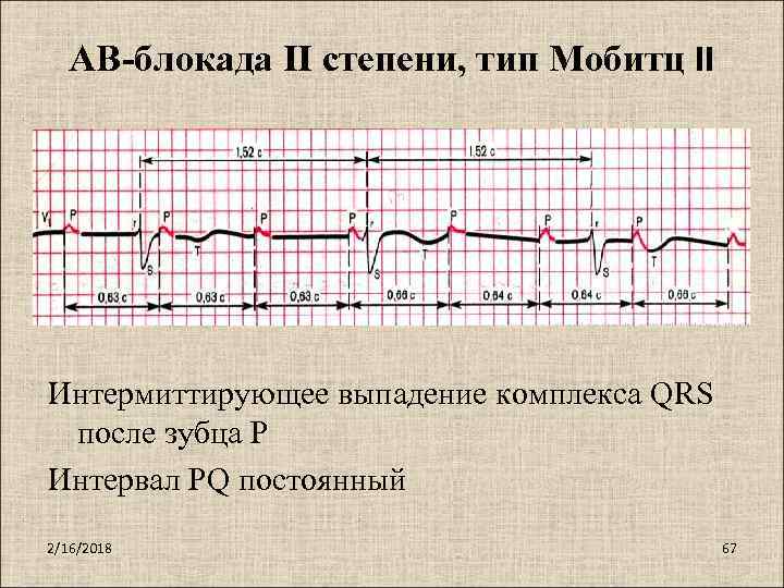 Блокада первой степени