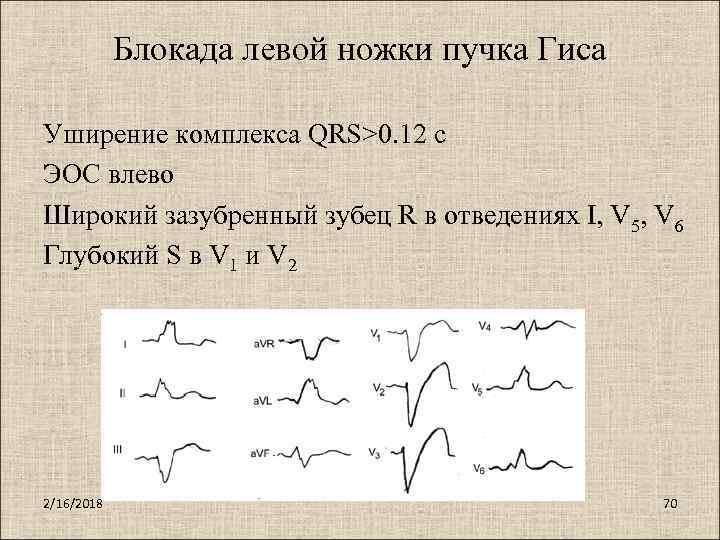 Блокада левой ножки пучка Гиса Уширение комплекса QRS>0. 12 с ЭОС влево Широкий зазубренный