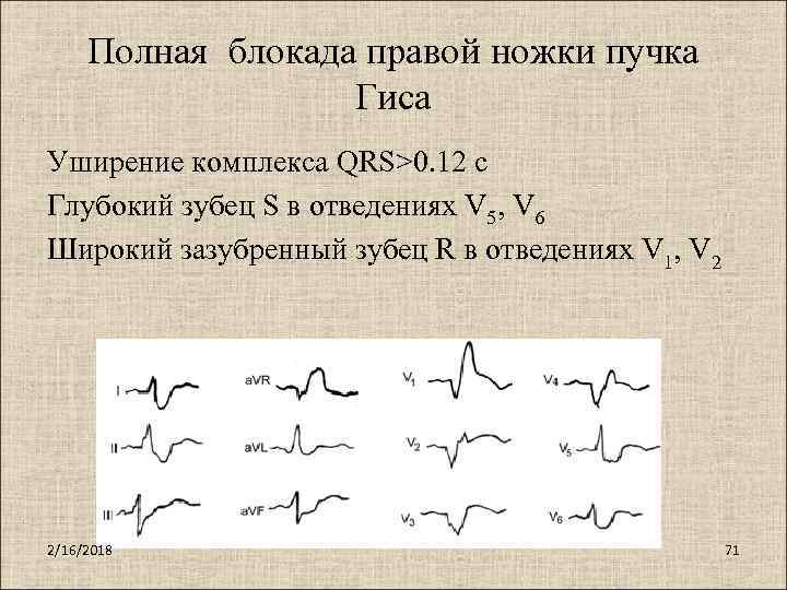 Полная блокада правой ножки пучка Гиса Уширение комплекса QRS>0. 12 с Глубокий зубец S