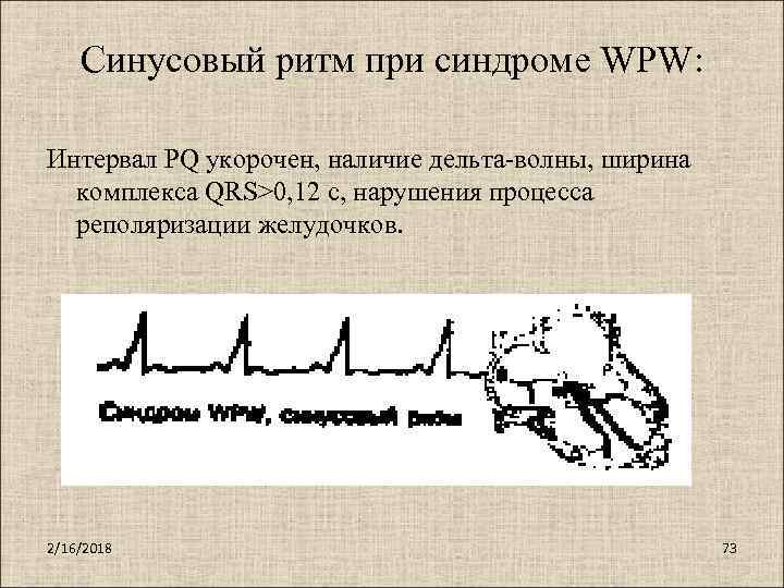 Синусовый ритм при синдроме WPW: Интервал PQ укорочен, наличие дельта-волны, ширина комплекса QRS>0, 12