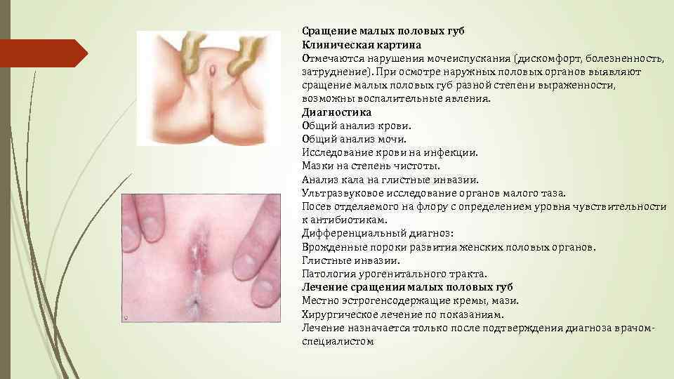 Сращение малых половых губ Клиническая картина Отмечаются нарушения мочеиспускания (дискомфорт, болезненность, затруднение). При осмотре