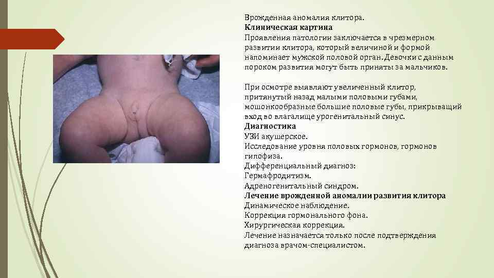 Врожденная аномалия клитора. Клиническая картина Проявления патологии заключается в чрезмерном развитии клитора, который величиной