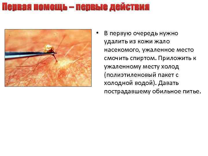 Первая помощь – первые действия • В первую очередь нужно удалить из кожи жало