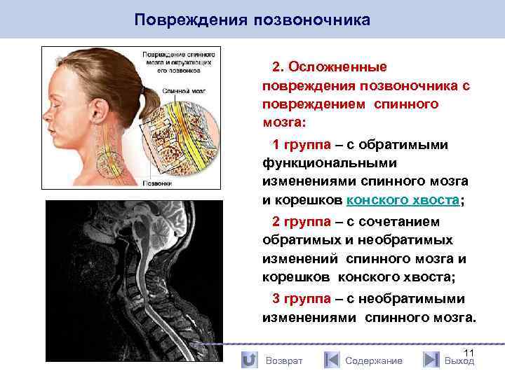 Повреждения позвоночника 2. Осложненные повреждения позвоночника с повреждением спинного мозга: 1 группа – с