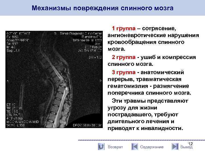 Сотрясение позвоночника