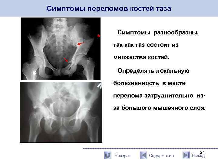 Симптомы переломов костей таза Симптомы разнообразны, так как таз состоит из множества костей. Определять
