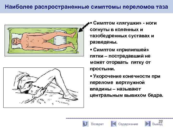 Наиболее распространенные симптомы переломов таза § Симптом «лягушки» - ноги согнуты в коленных и