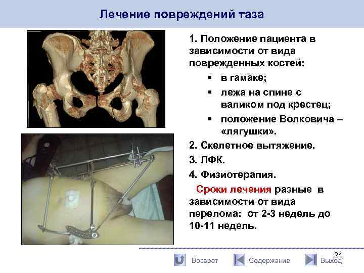 Лечение повреждений таза 1. Положение пациента в зависимости от вида поврежденных костей: § в