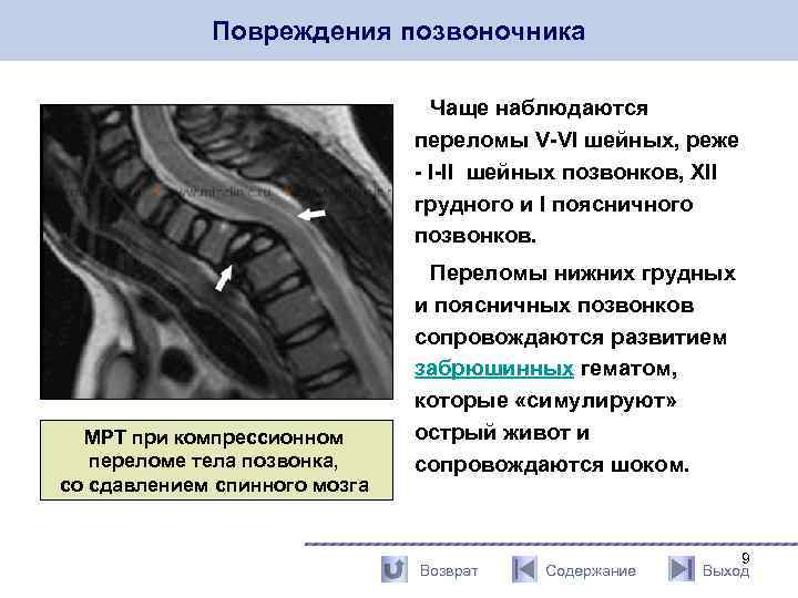 Повреждения позвоночника Чаще наблюдаются переломы V-VI шейных, реже - I-II шейных позвонков, XII грудного