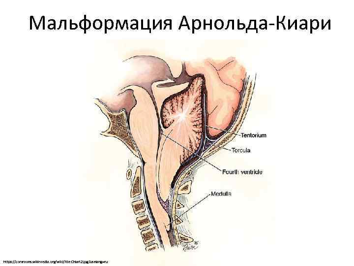 Мальформация Арнольда-Киари https: //commons. wikimedia. org/wiki/File: Chiari 2. jpg? uselang=ru 