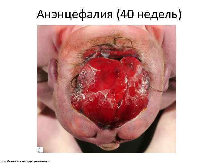 Анэнцефалия (40 недель) http: //www. humpath. com/spip. php? article 3410 