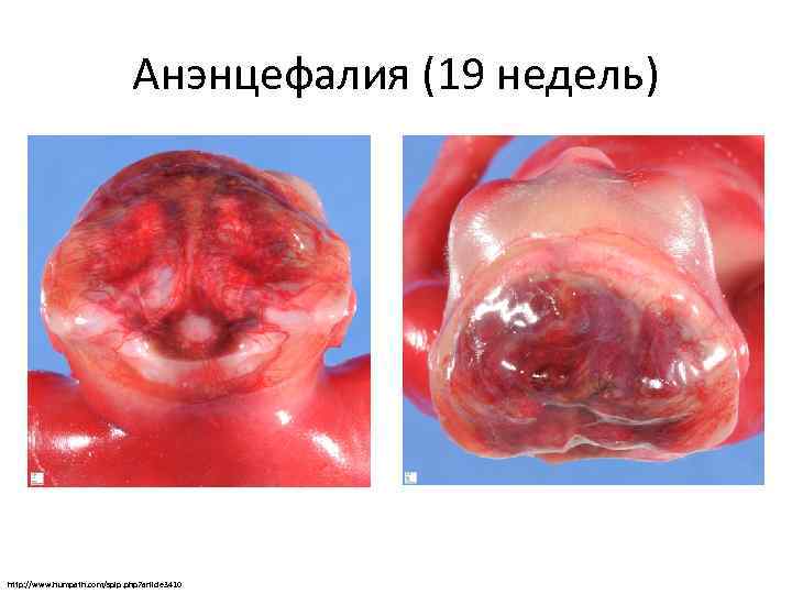 Анэнцефалия (19 недель) http: //www. humpath. com/spip. php? article 3410 