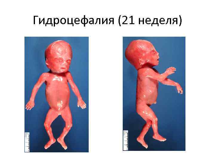 Гидроцефалия (21 неделя) 