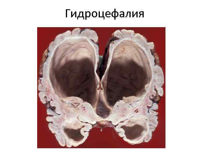 Гидроцефалия 