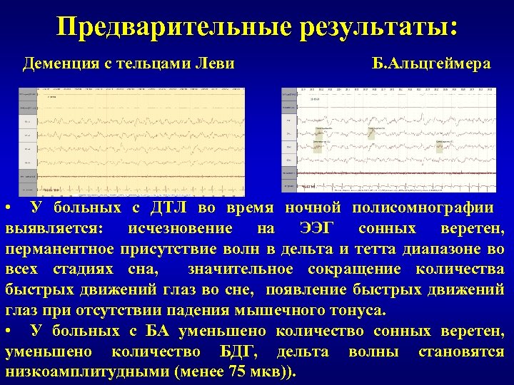 Деменции с тельцами. ЭЭГ при деменции заключение. Болезнь Альцгеймера ЭЭГ. ЭЭГ при альцгеймере. Диагностическими признаками деменции с тельцами Леви являются.