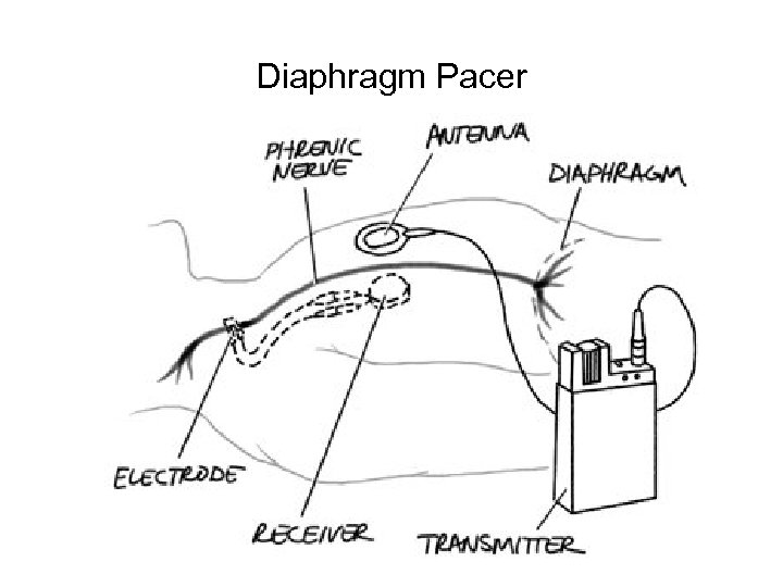 Diaphragm Pacer 