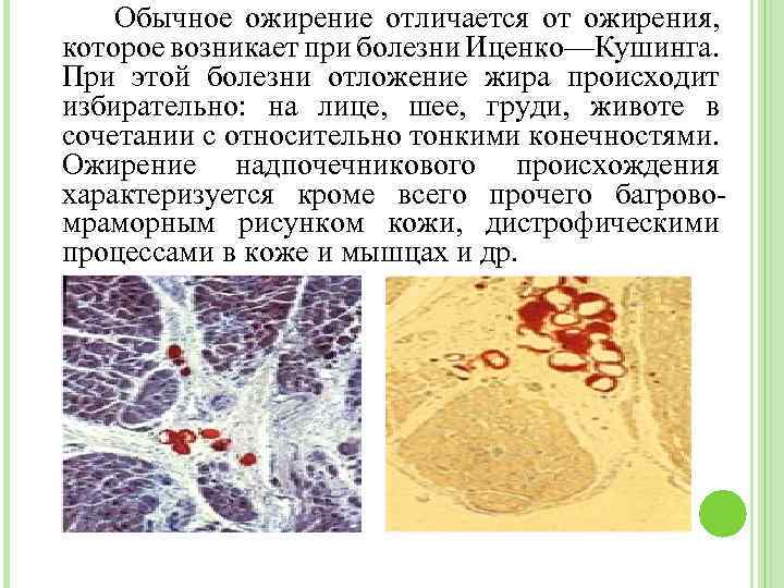 Обычное ожирение отличается от ожирения, которое возникает при болезни Иценко—Кушинга. При этой болезни отложение