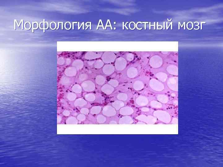 Морфология АА: костный мозг 