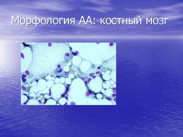 Морфология АА: костный мозг 