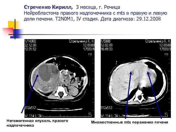 Стреченко Кирилл, 3 месяца, г. Речица Нейробластома правого надпочечника с mts в правую и