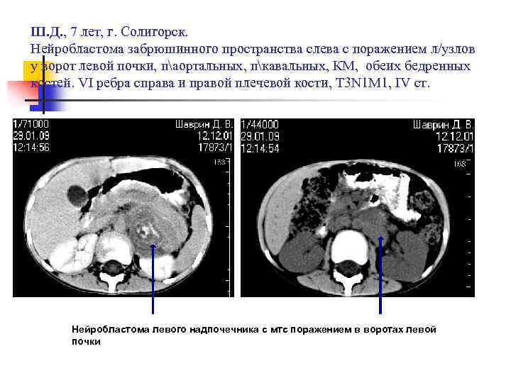 Ш. Д. , 7 лет, г. Солигорск. Нейробластома забрюшинного пространства слева с поражением л/узлов