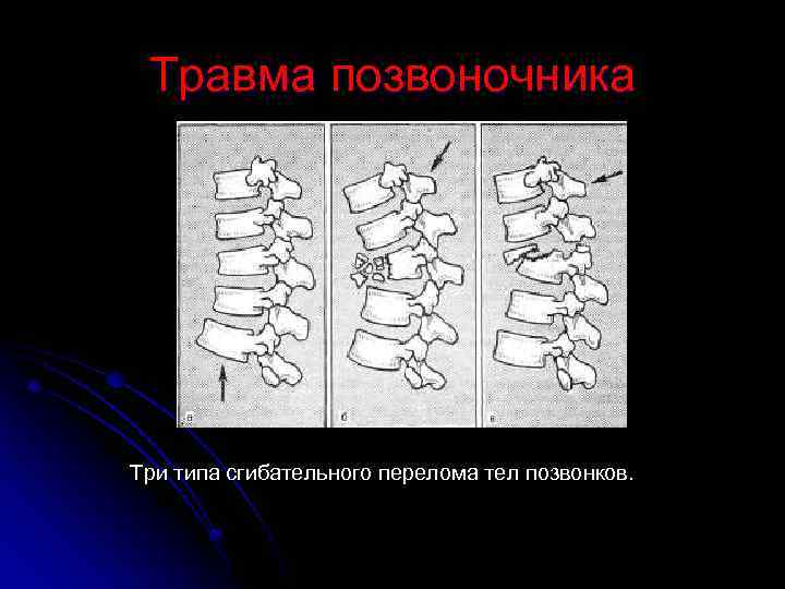 Травма позвоночника Три типа сгибательного перелома тел позвонков. 