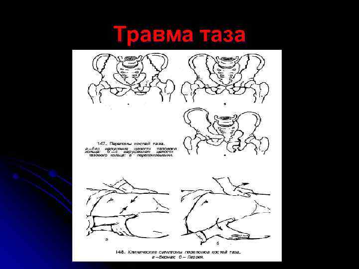 Травма таза 