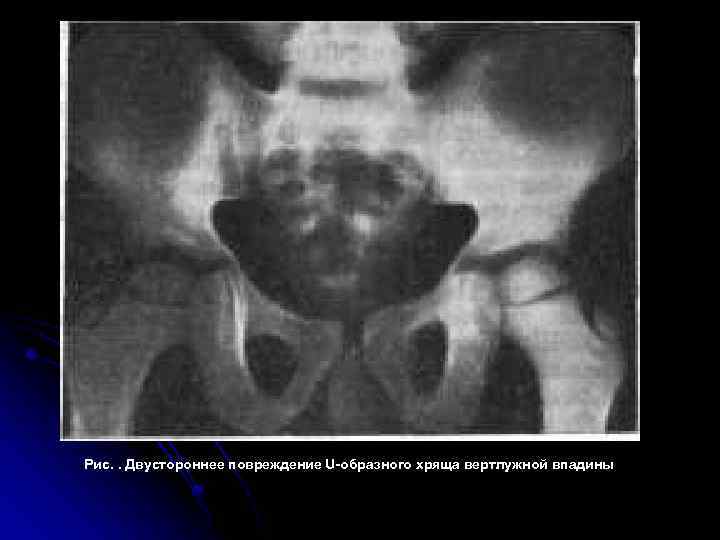 Рис. . Двустороннее повреждение U-образного хряща вертлужной впадины 