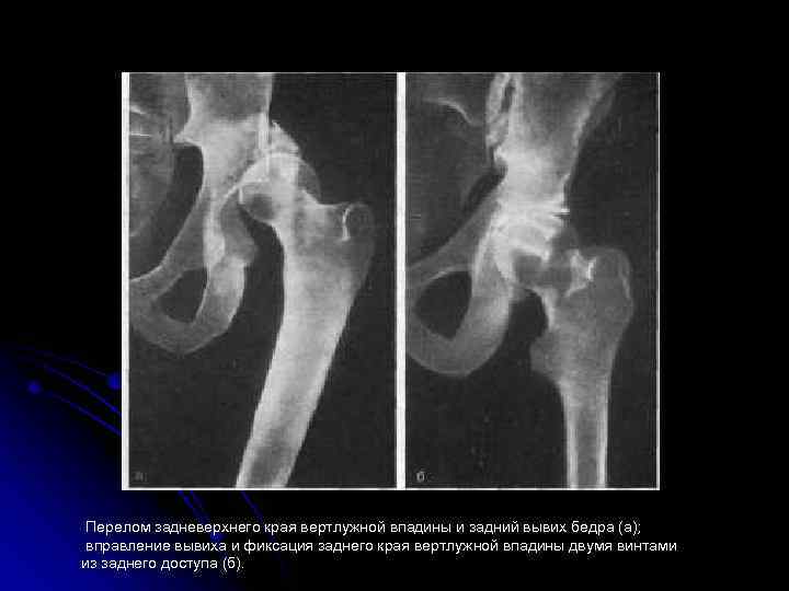 Перелом вертлужной впадины презентация