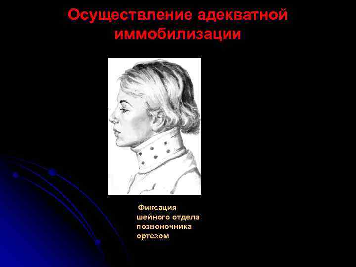 Осуществление адекватной иммобилизации Фиксация шейного отдела позвоночника ортезом 