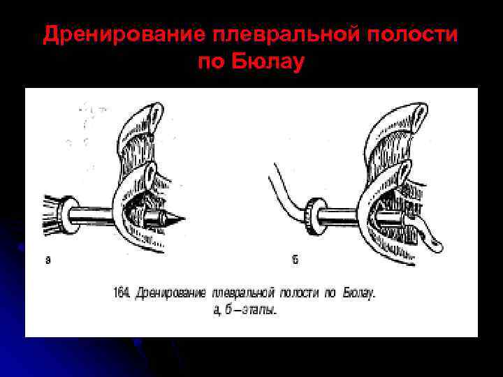 Дренирование плевральной полости по Бюлау 