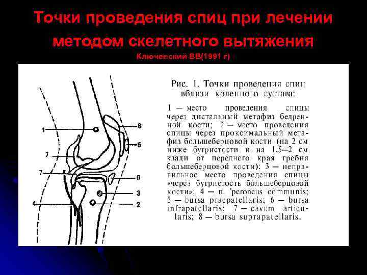 Точки проведения спиц при лечении методом скелетного вытяжения Ключевский ВВ(1991 г) 