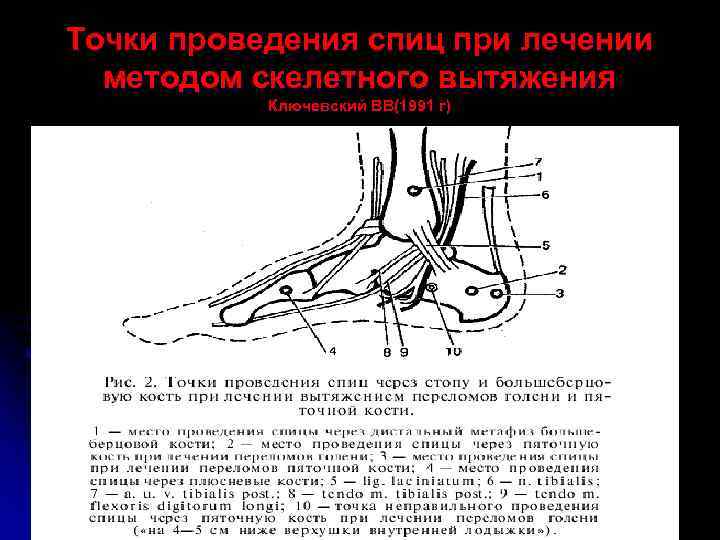 Точки проведения спиц при лечении методом скелетного вытяжения Ключевский ВВ(1991 г) 