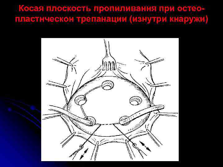 Косая плоскость пропиливання при остеопластнческон трепанации (изнутри кнаружи) 