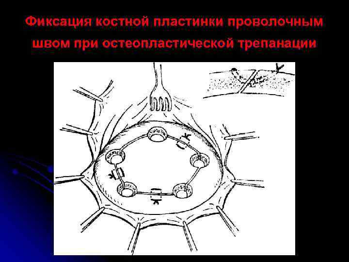 Фиксация костной пластинки проволочным швом при остеопластической трепанации 