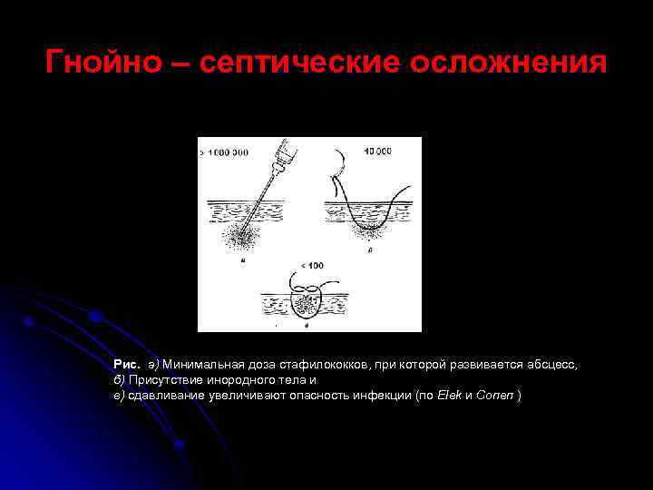 Гнойно – септические осложнения Рис. а) Минимальная доза стафилококков, при которой развивается абсцесс, б)