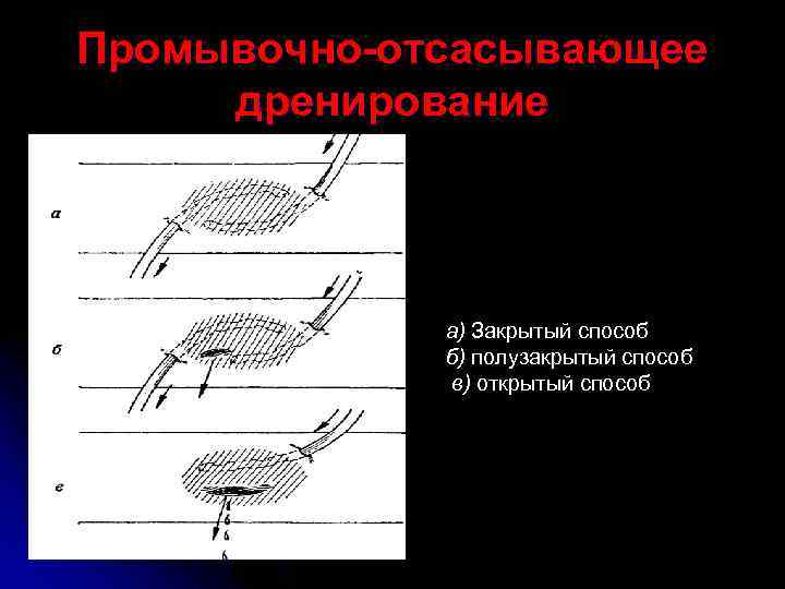 Промывочно-отсасывающее дренирование а) Закрытый способ б) полузакрытый способ в) открытый способ 