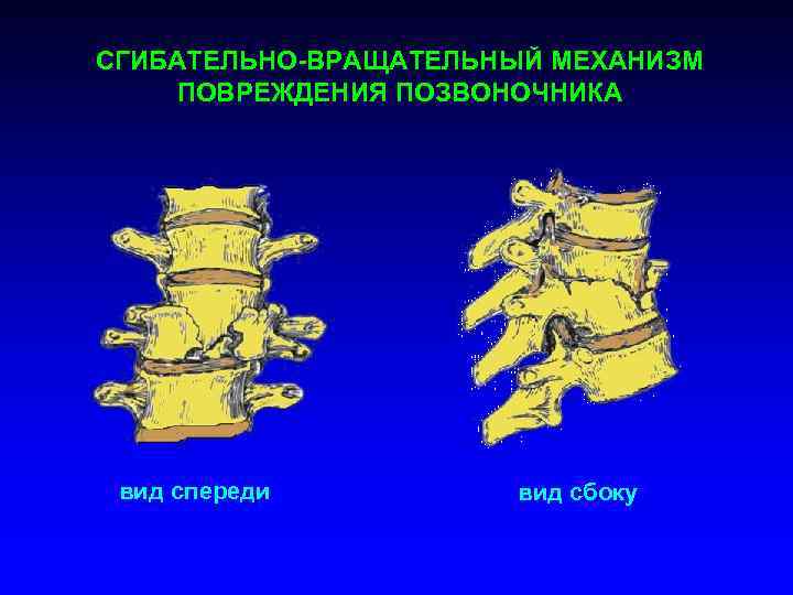 СГИБАТЕЛЬНО-ВРАЩАТЕЛЬНЫЙ МЕХАНИЗМ ПОВРЕЖДЕНИЯ ПОЗВОНОЧНИКА вид спереди вид сбоку 