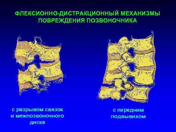 Механизм повреждения. Флексионно ротационный перелом позвоночника. Дистракционный перелом позвонка. Флексионно-дистракционные повреждения позвоночника. Механизмы повреждения позвоночника.