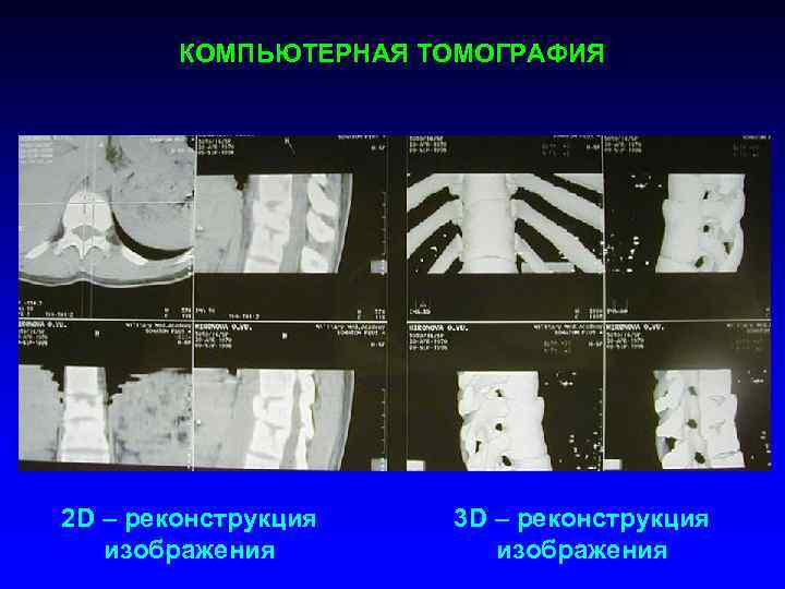КОМПЬЮТЕРНАЯ ТОМОГРАФИЯ 2 D – реконструкция изображения 3 D – реконструкция изображения 