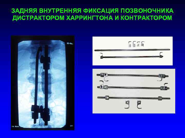 ЗАДНЯЯ ВНУТРЕННЯЯ ФИКСАЦИЯ ПОЗВОНОЧНИКА ДИСТРАКТОРОМ ХАРРИНГТОНА И КОНТРАКТОРОМ 