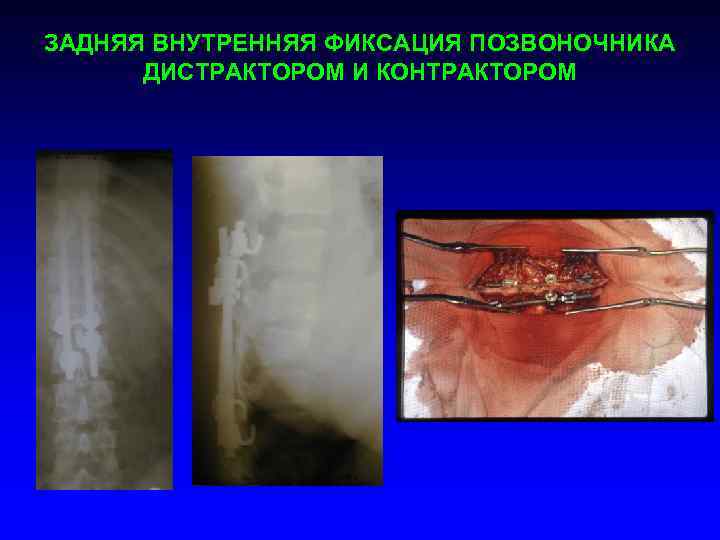 ЗАДНЯЯ ВНУТРЕННЯЯ ФИКСАЦИЯ ПОЗВОНОЧНИКА ДИСТРАКТОРОМ И КОНТРАКТОРОМ 